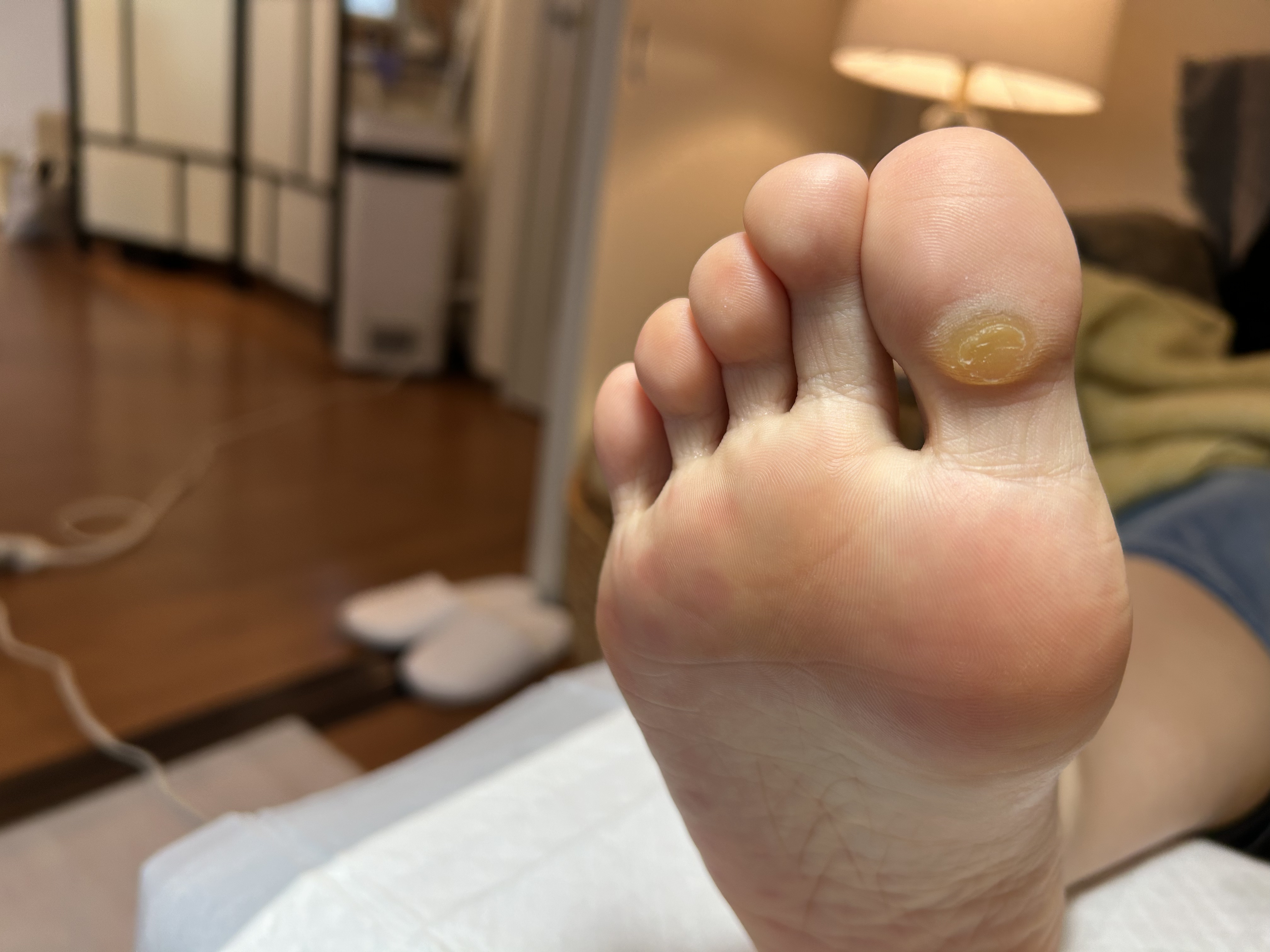 4. たこの悩みを解消